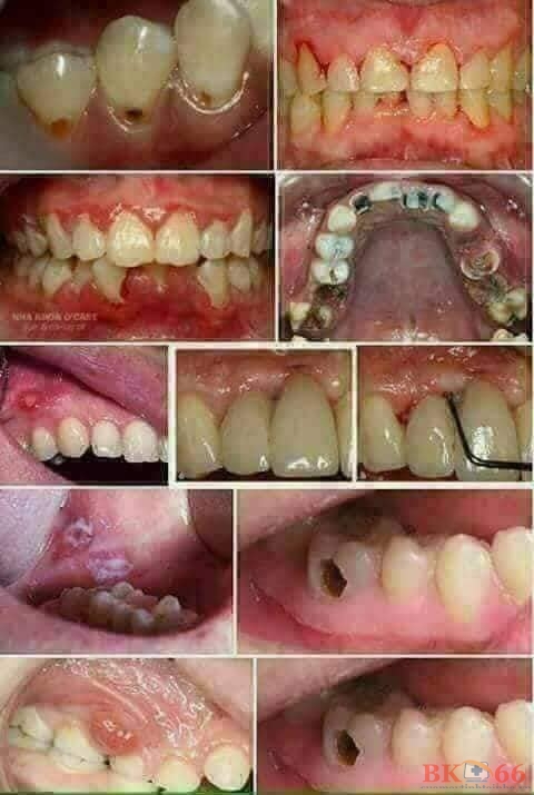 Bệnh răng miệng